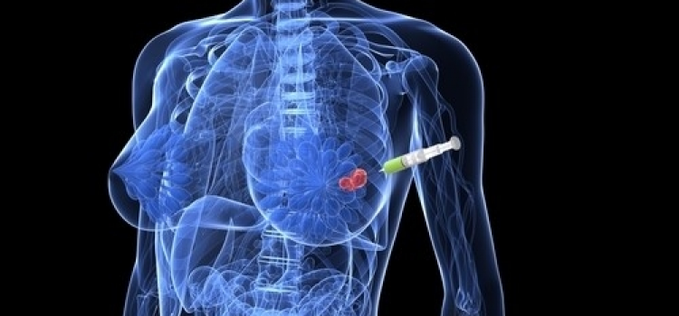 Medicina X Câncer de Mama